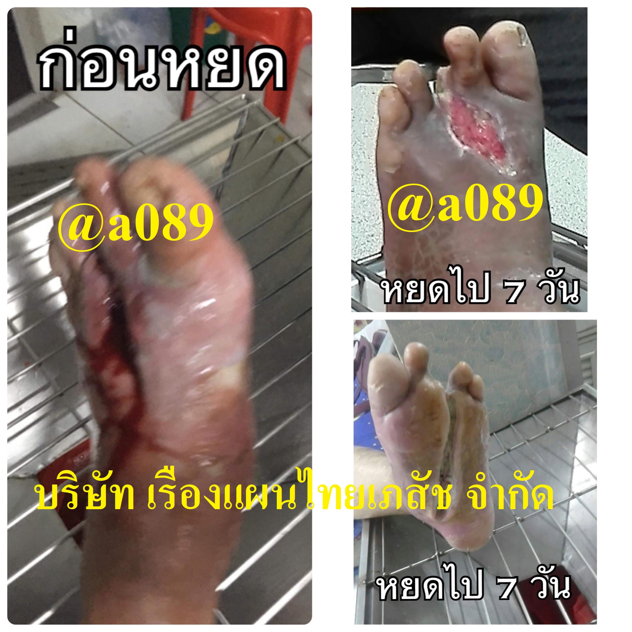 เบาหวาน น้ำมันกัญชา